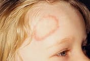 girl has Ringworm 